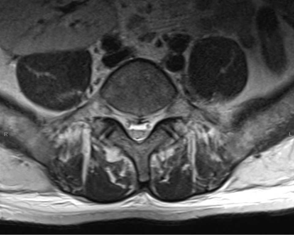 Epidural Hematoma with Spinal Cord Puncture Wound - CTisus CT Scan