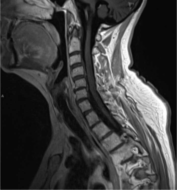 Interspinous Ligamentous Injury - CTisus CT Scan