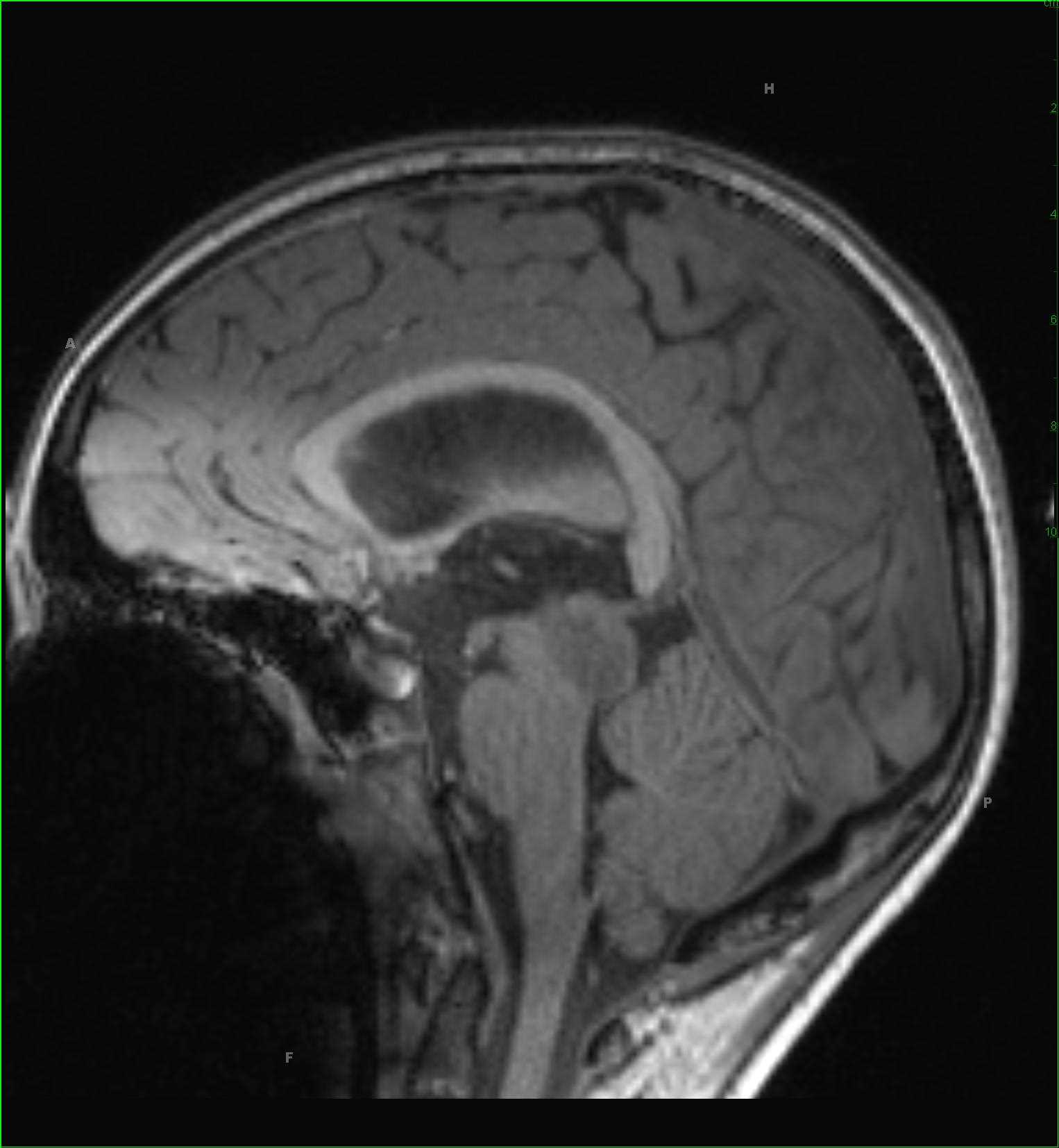 Tectal Plate Glioma - CTisus CT Scan