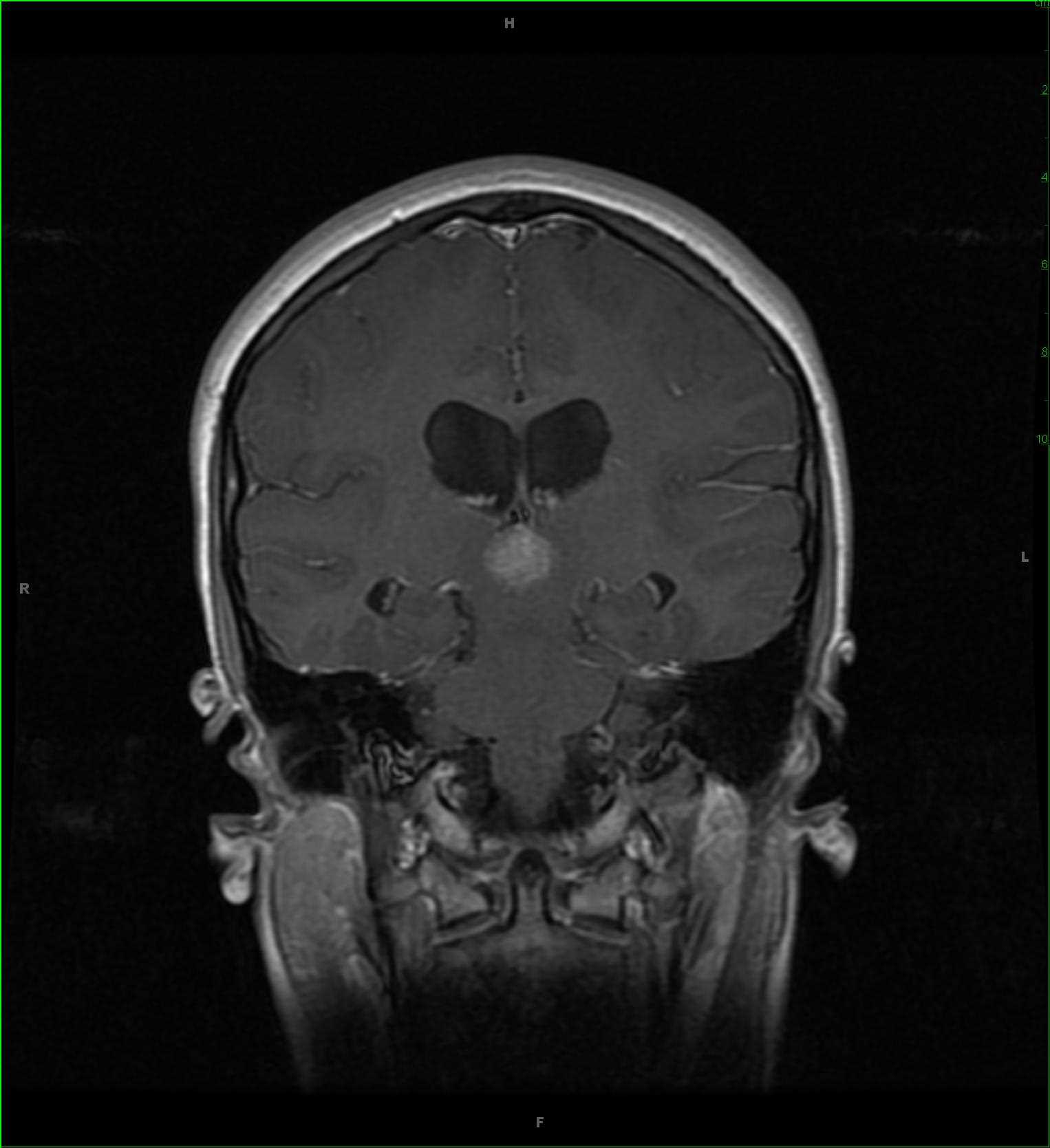 Pineal Tumor, Pineocytoma - CTisus CT Scan
