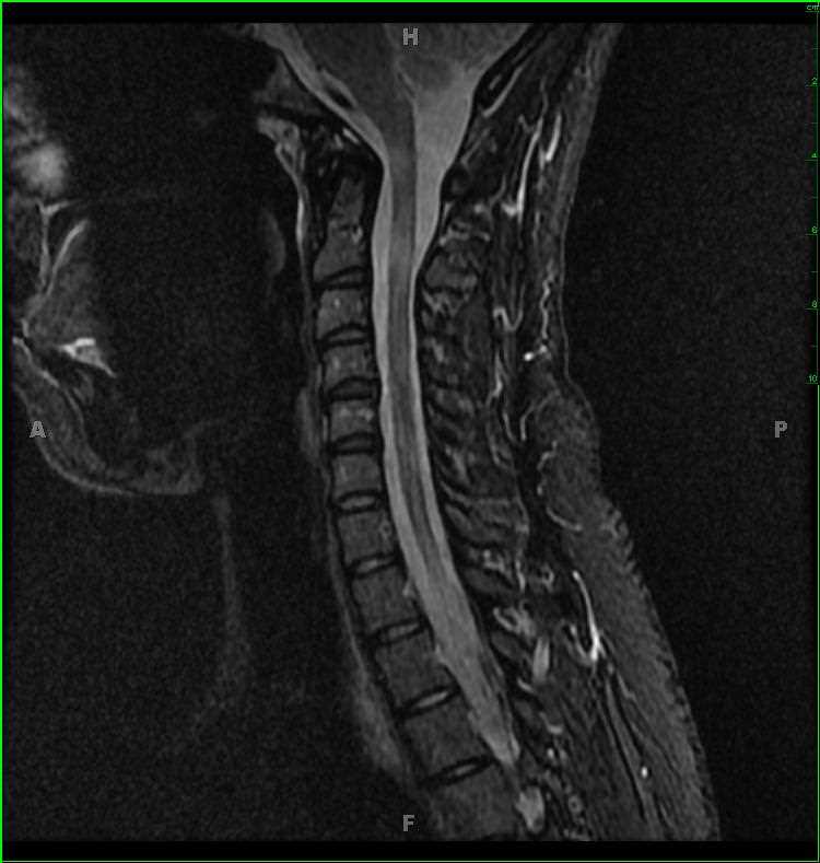 Multiple Sclerosis - CTisus CT Scan