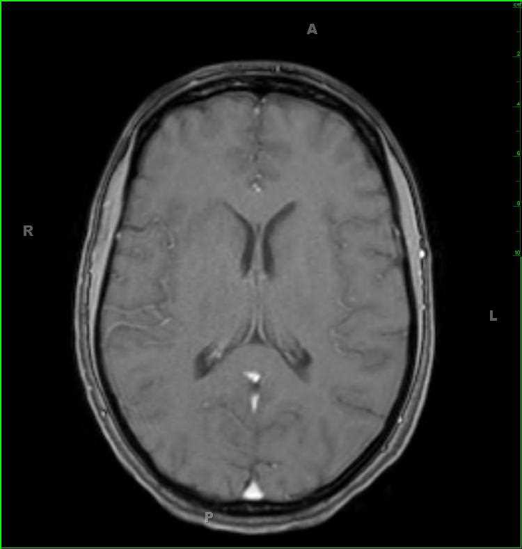 Limbic Encephalitis - CTisus CT Scan