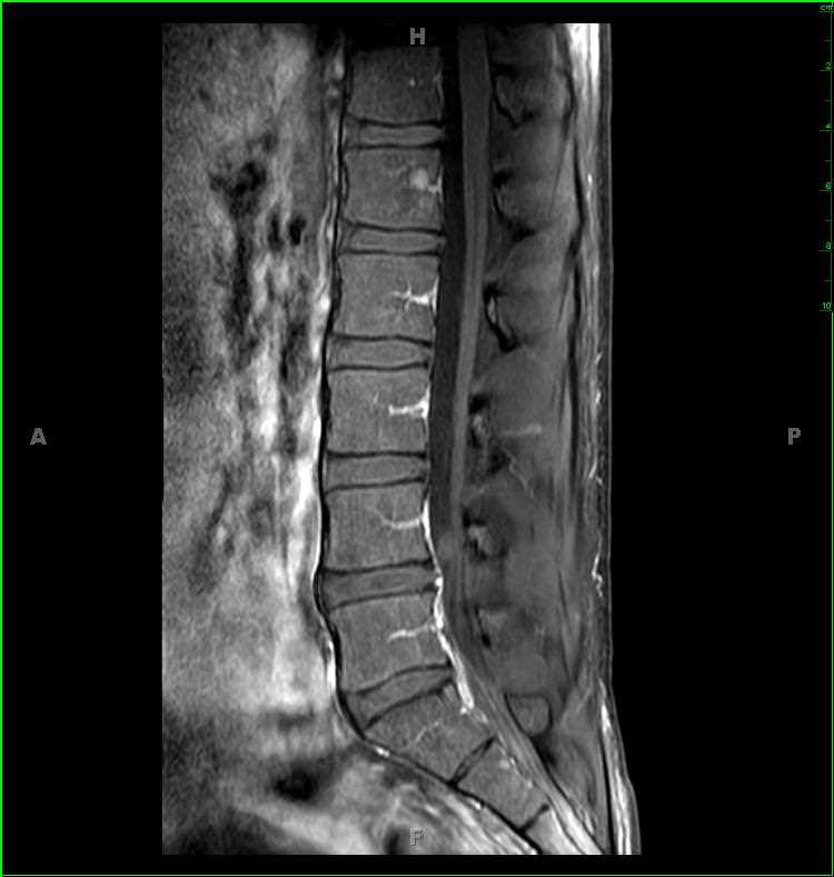 Sequestered Disc - CTisus CT Scan