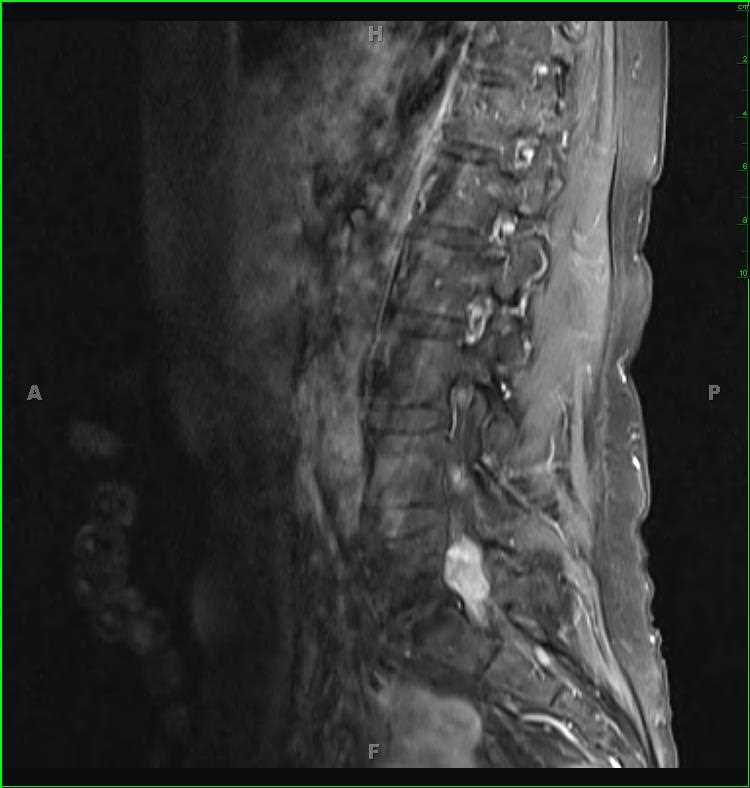 Lumbar Spinal Schwannoma - CTisus CT Scan