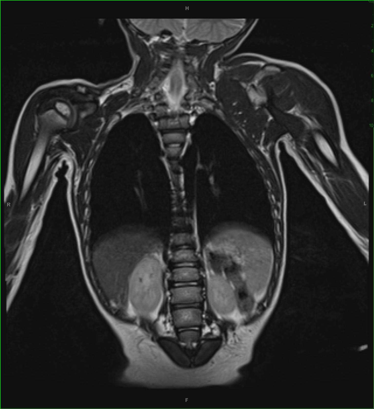 Caudal Regression Syndrome, secondary to maternal diabetes - CTisus CT Scan