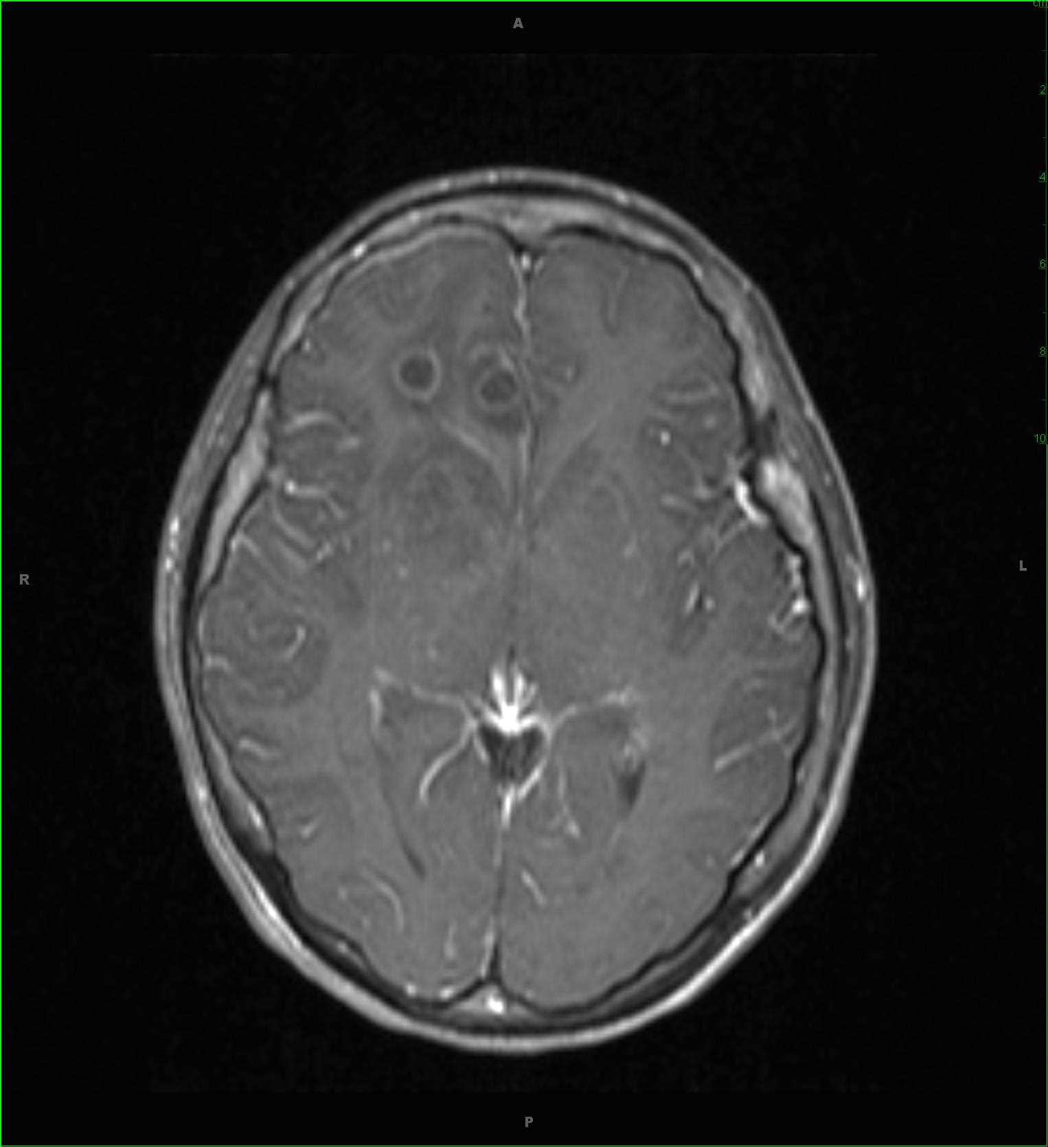 Brain Abscesses, Multiple - CTisus CT Scan