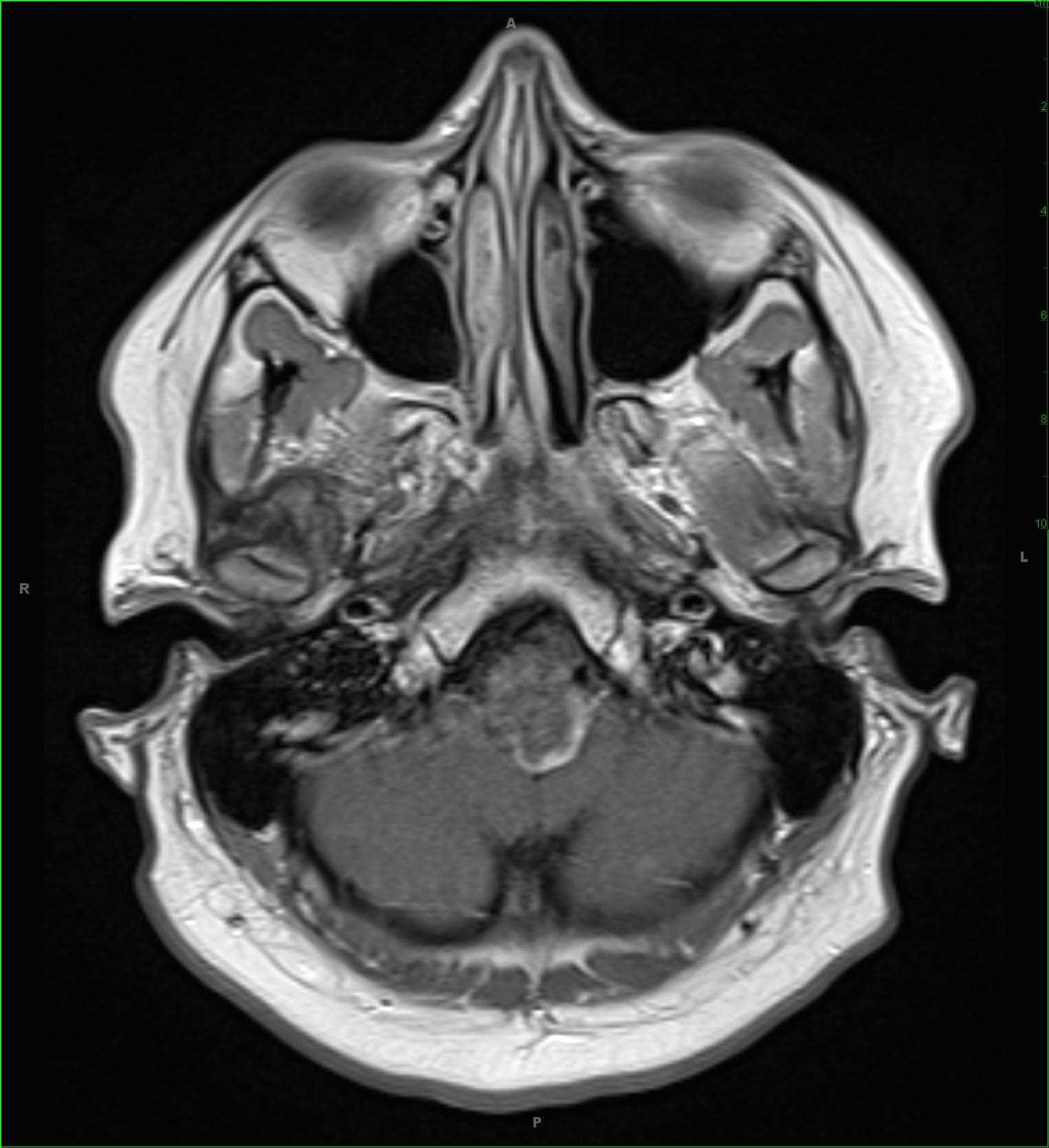 Brainstem Glioma - CTisus CT Scan