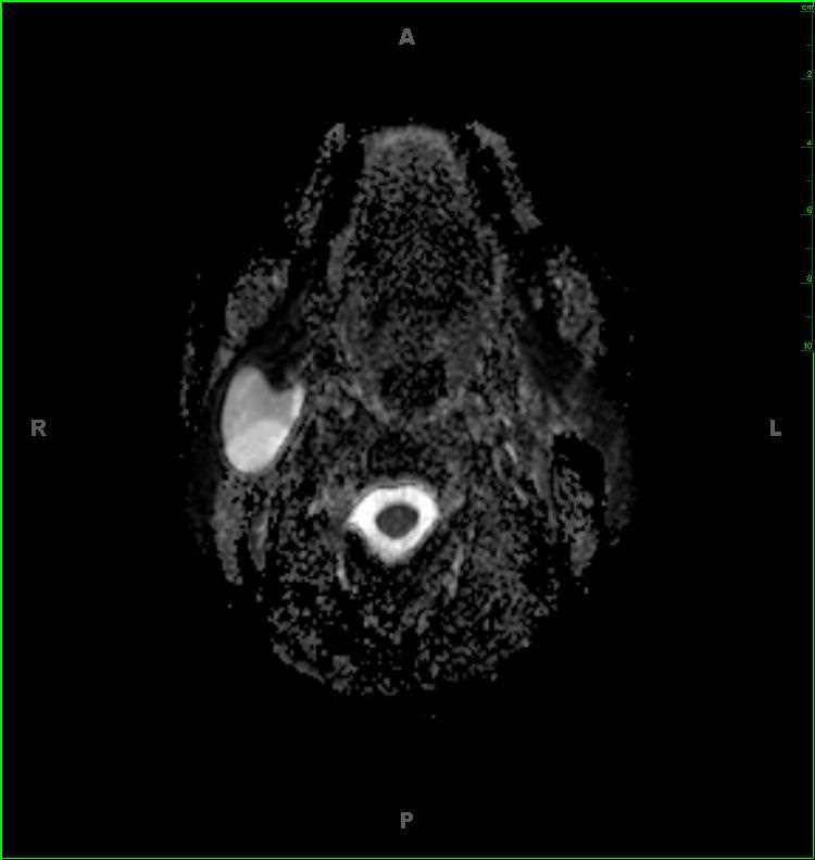 Benign Lymphoepithelial Lesion (Parotid Cyst) - CTisus CT Scan