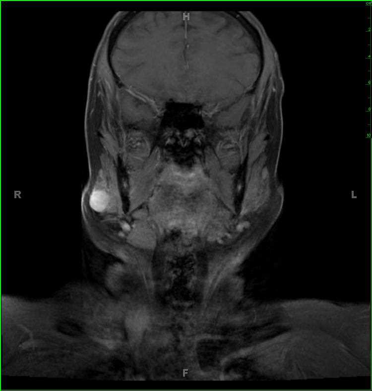 Benign Mixed Tumor, Parotid (Pleomorphic Adenoma) - CTisus CT Scan