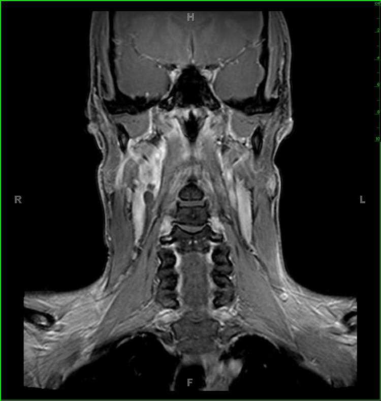 Vocal Cord Paralysis, right - CTisus CT Scan
