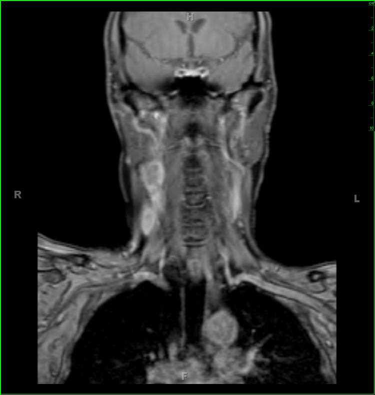 Glomus Vagale Paraganglioma, right - CTisus CT Scan