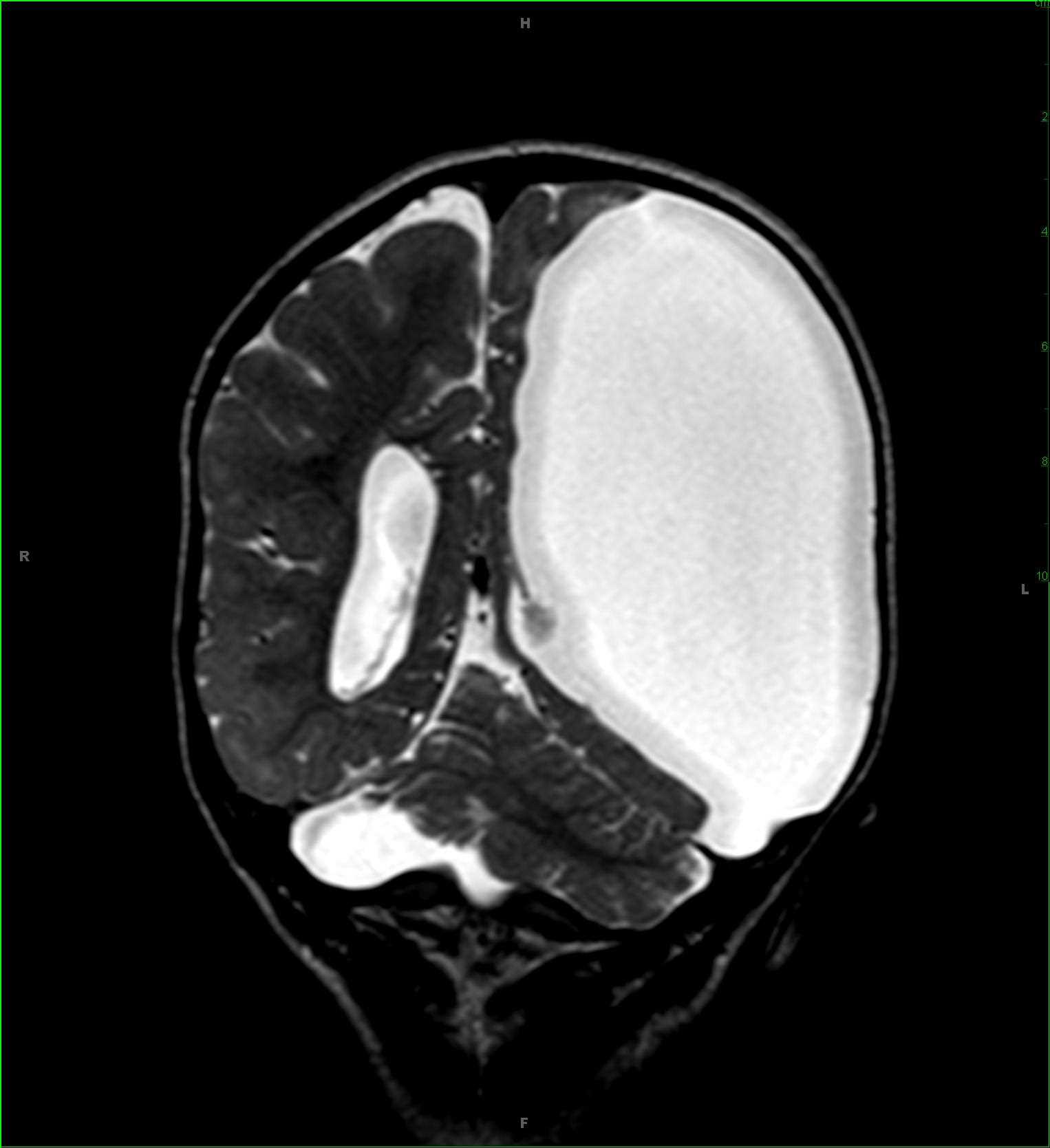 Porencephalic Cyst - CTisus CT Scan