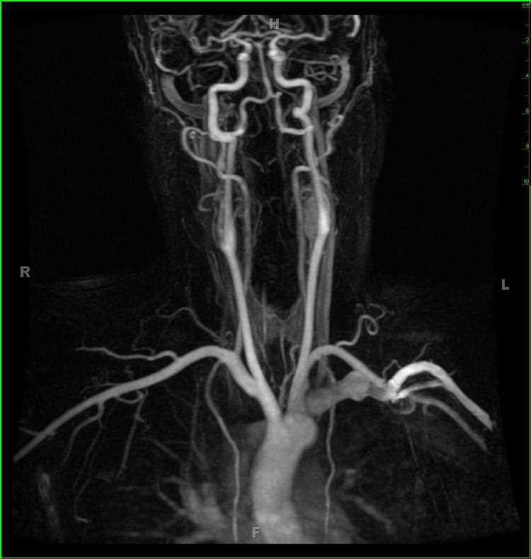 Multiple Hereditary Paraganglioma and Pheochromocytoma Syndrome - CTisus CT Scan