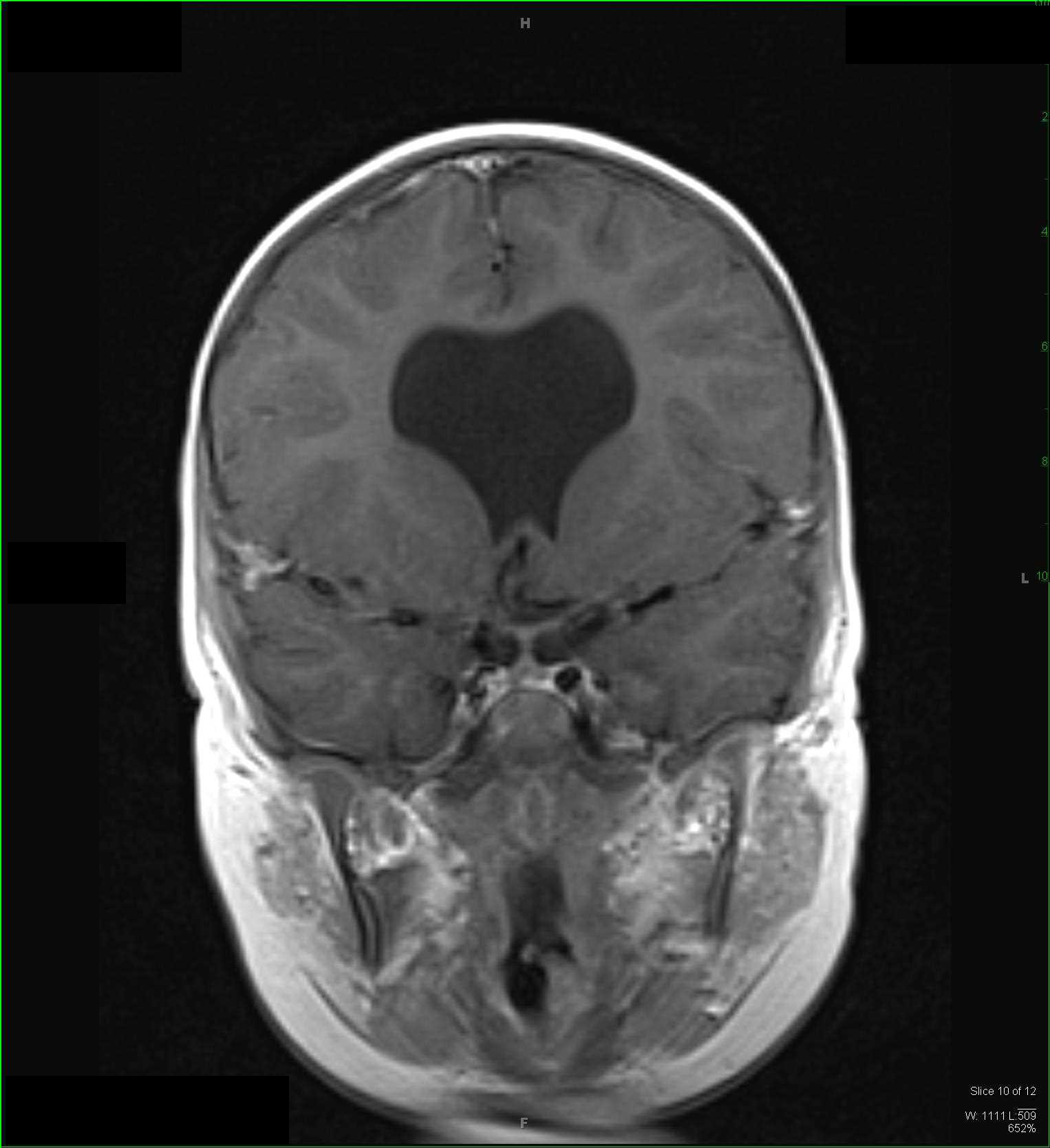 Dandy-Walker Spectrum and Septo-optic Dysplasia - CTisus CT Scan