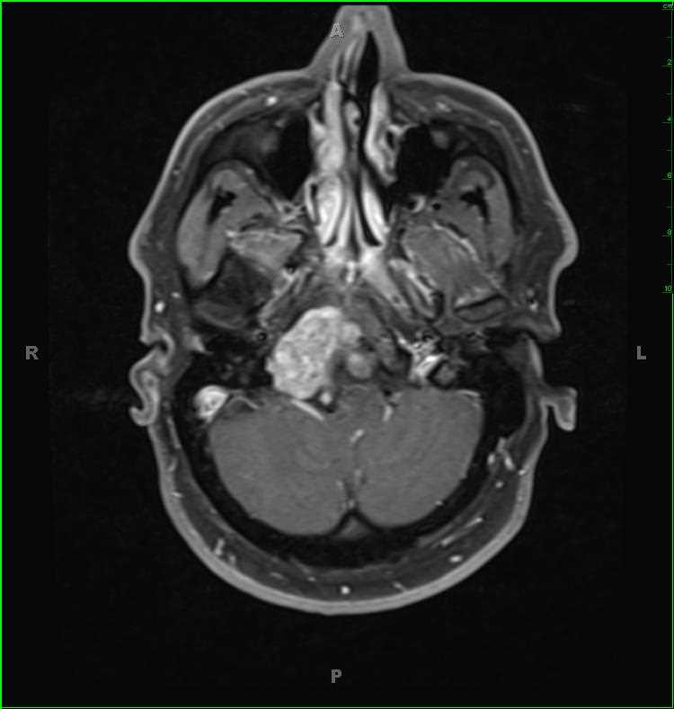 Chordoma - CTisus CT Scan