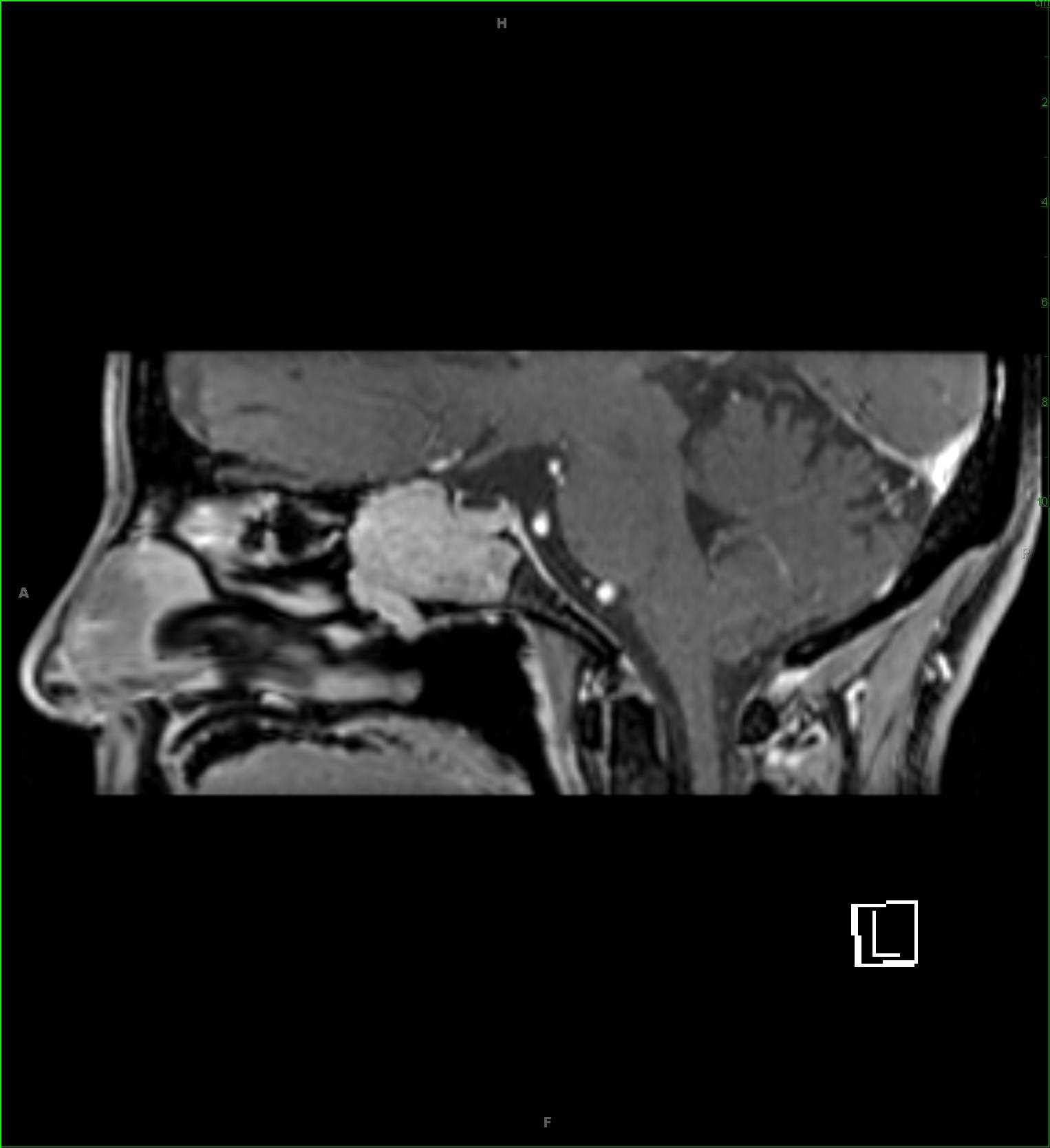 Inverted Papilloma, sphenoid sinus - CTisus CT Scan