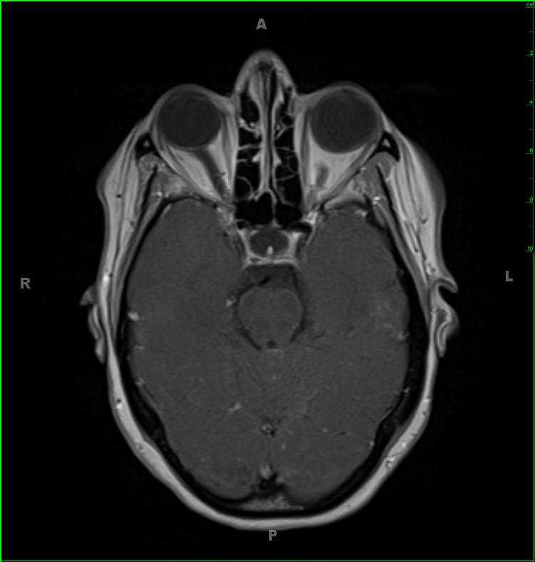 Leptomeningeal Metastatic Disease, lung adenocarcinoma primary - CTisus CT Scan