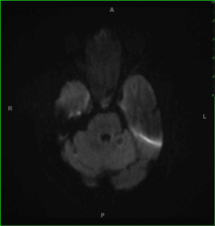 Sinonasal Undifferentiated Carcinoma (SNUC) - CTisus CT Scan