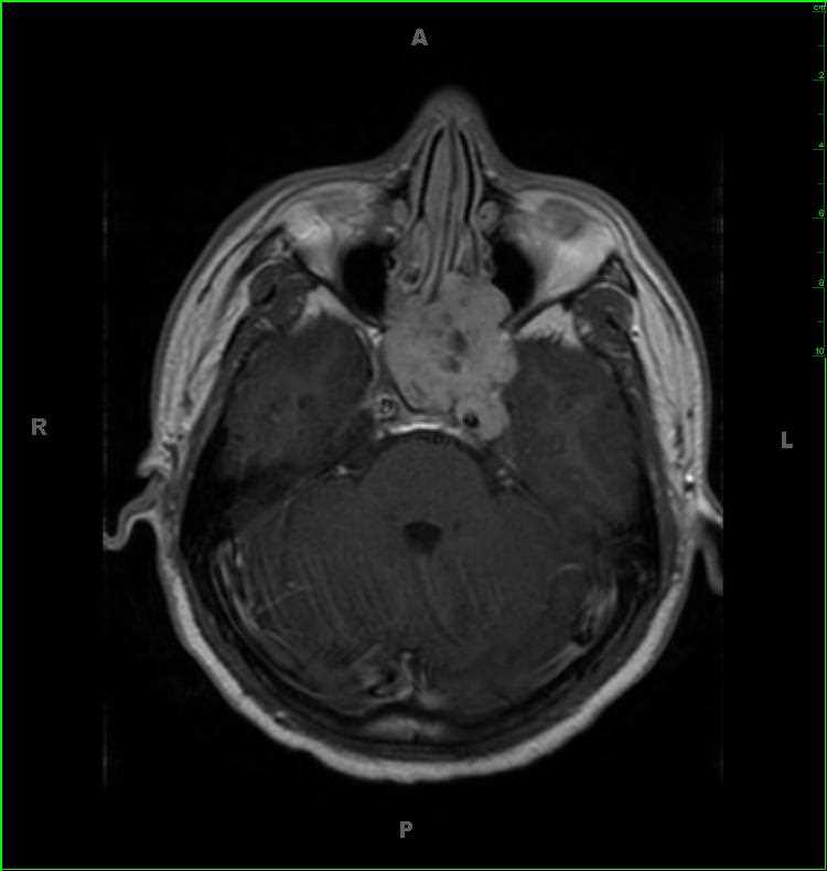 Adenoid Cystic Carcinoma, sphenoid sinus - CTisus CT Scan