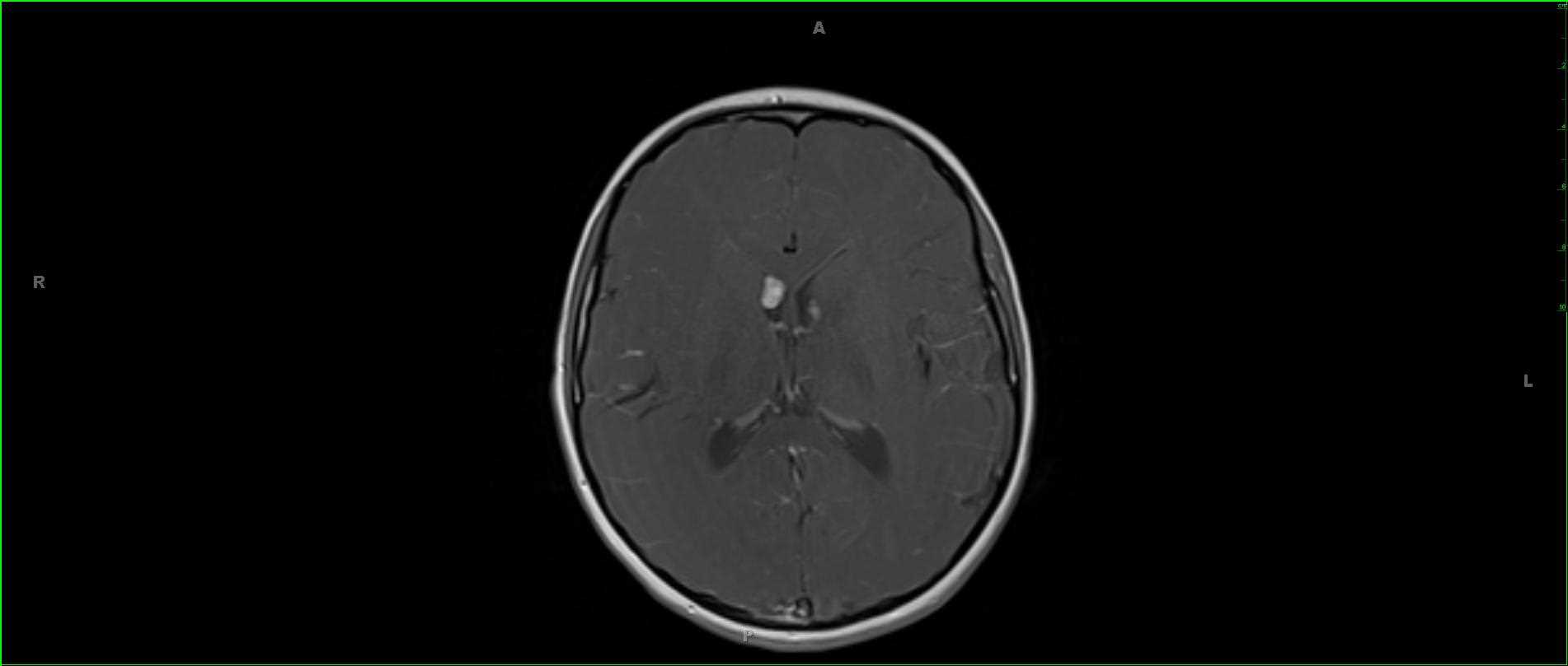 Tuberous Sclerosis - CTisus CT Scan