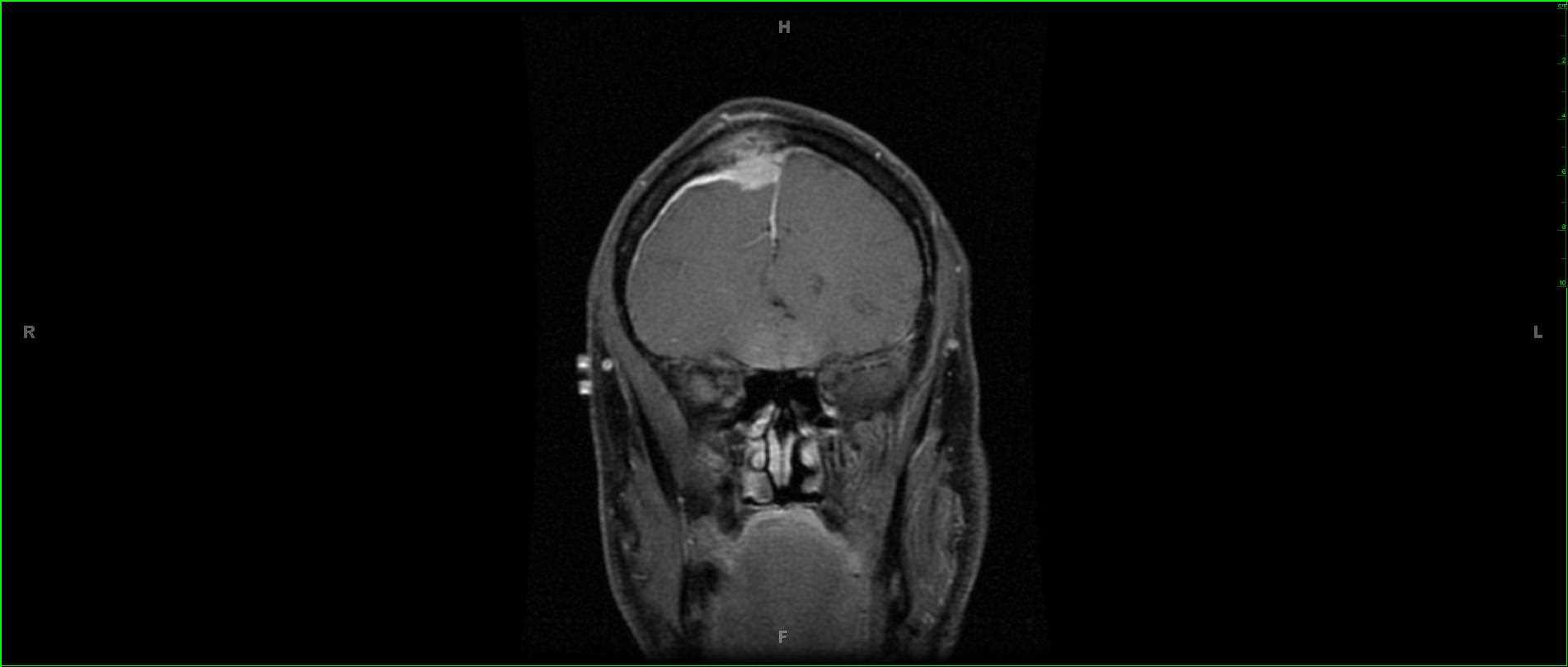 Intra-osseous Meningioma and Subgaleal Invasion - CTisus CT Scan