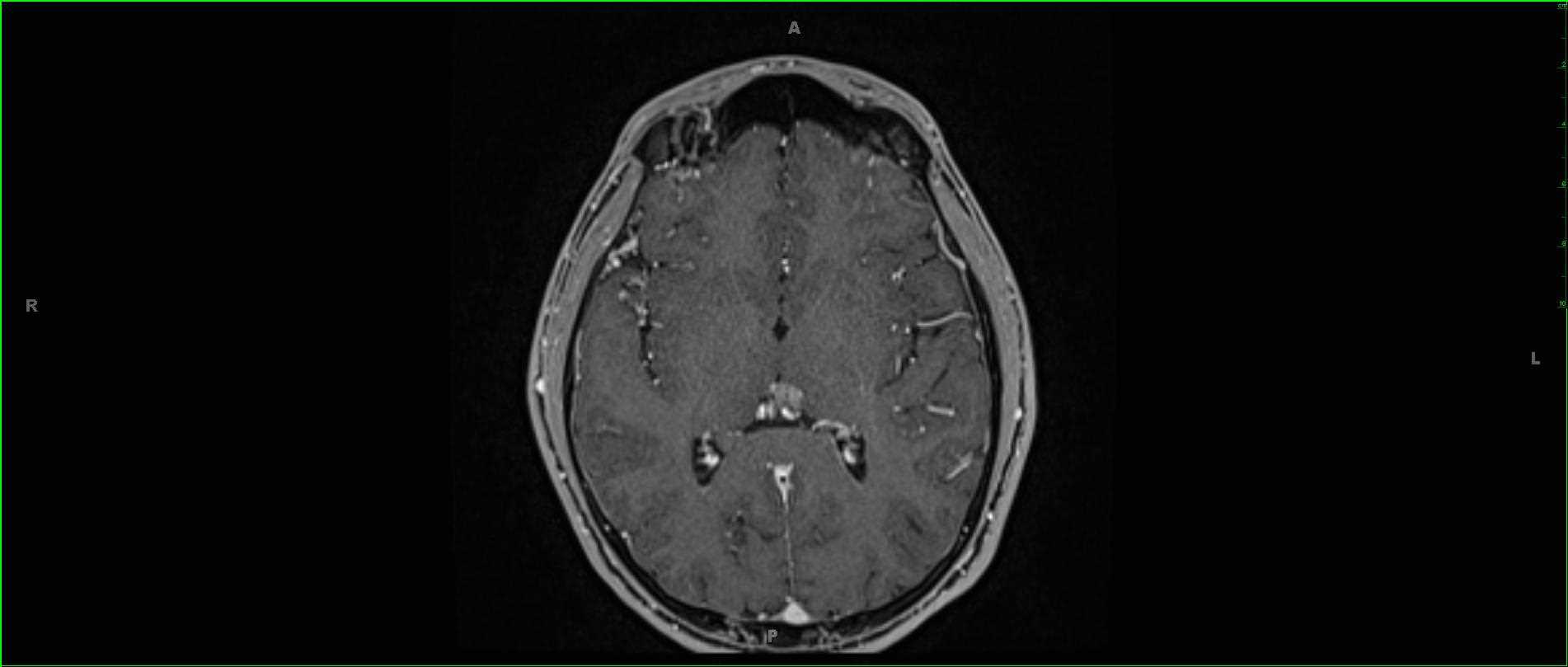 Germinoma, Pineal - CTisus CT Scan