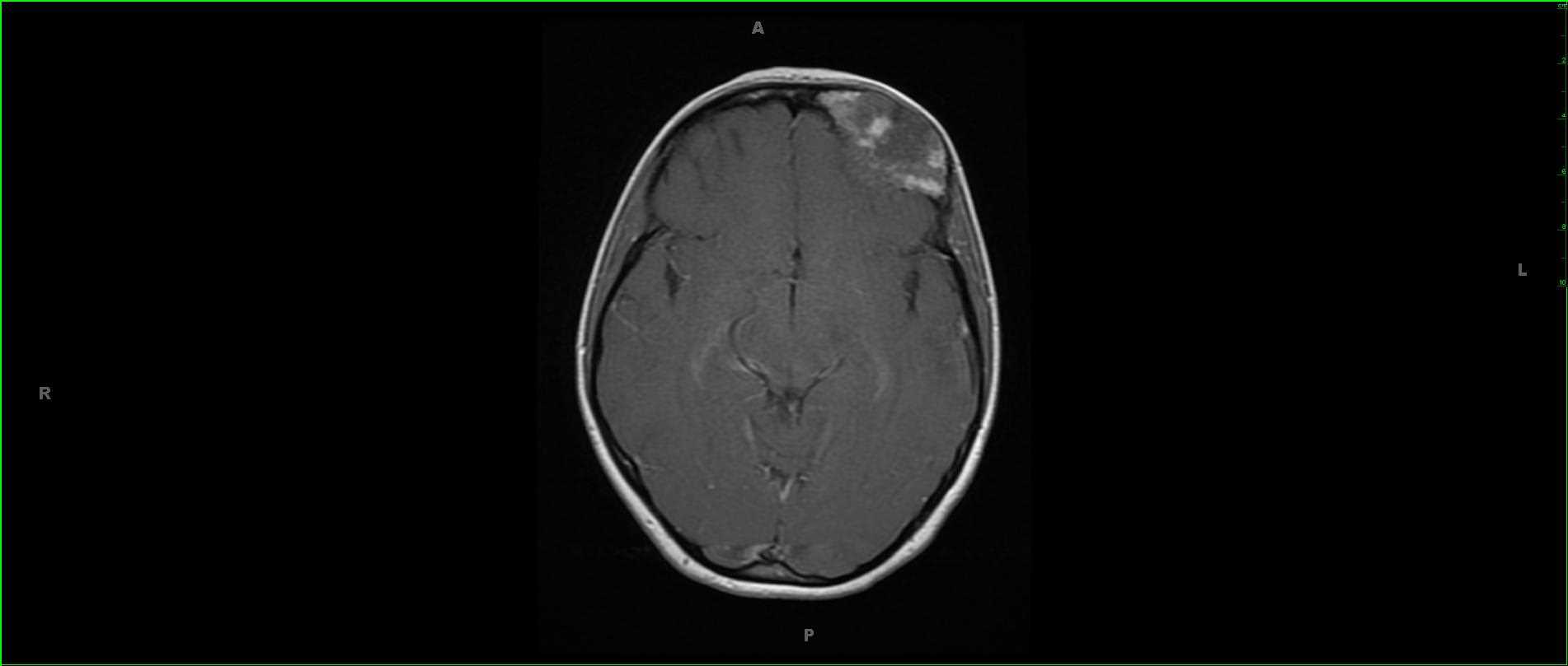 Fibrous Dysplasia, Left Frontal Bone - CTisus CT Scan
