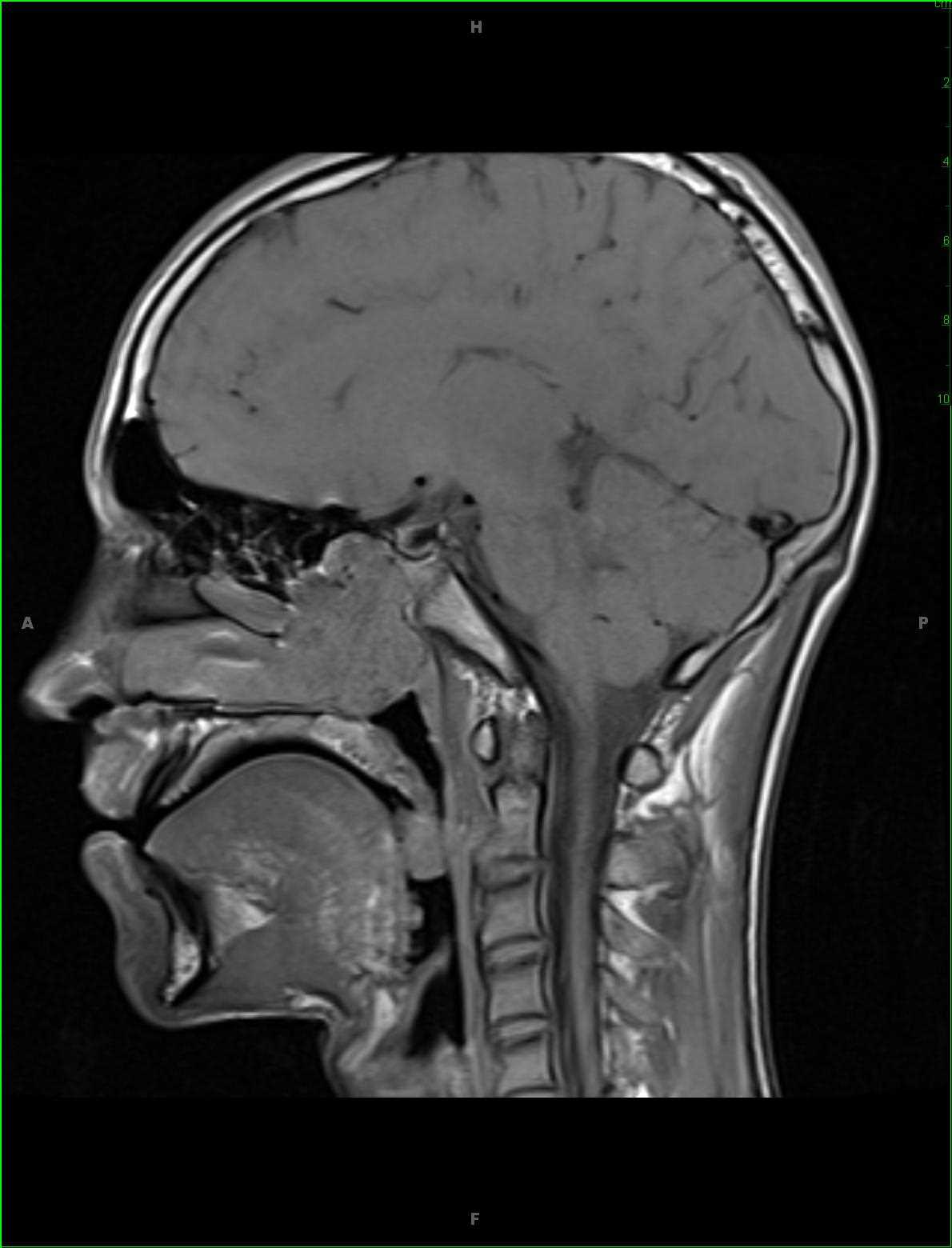 Juvenile Angiofibroma - CTisus CT Scan