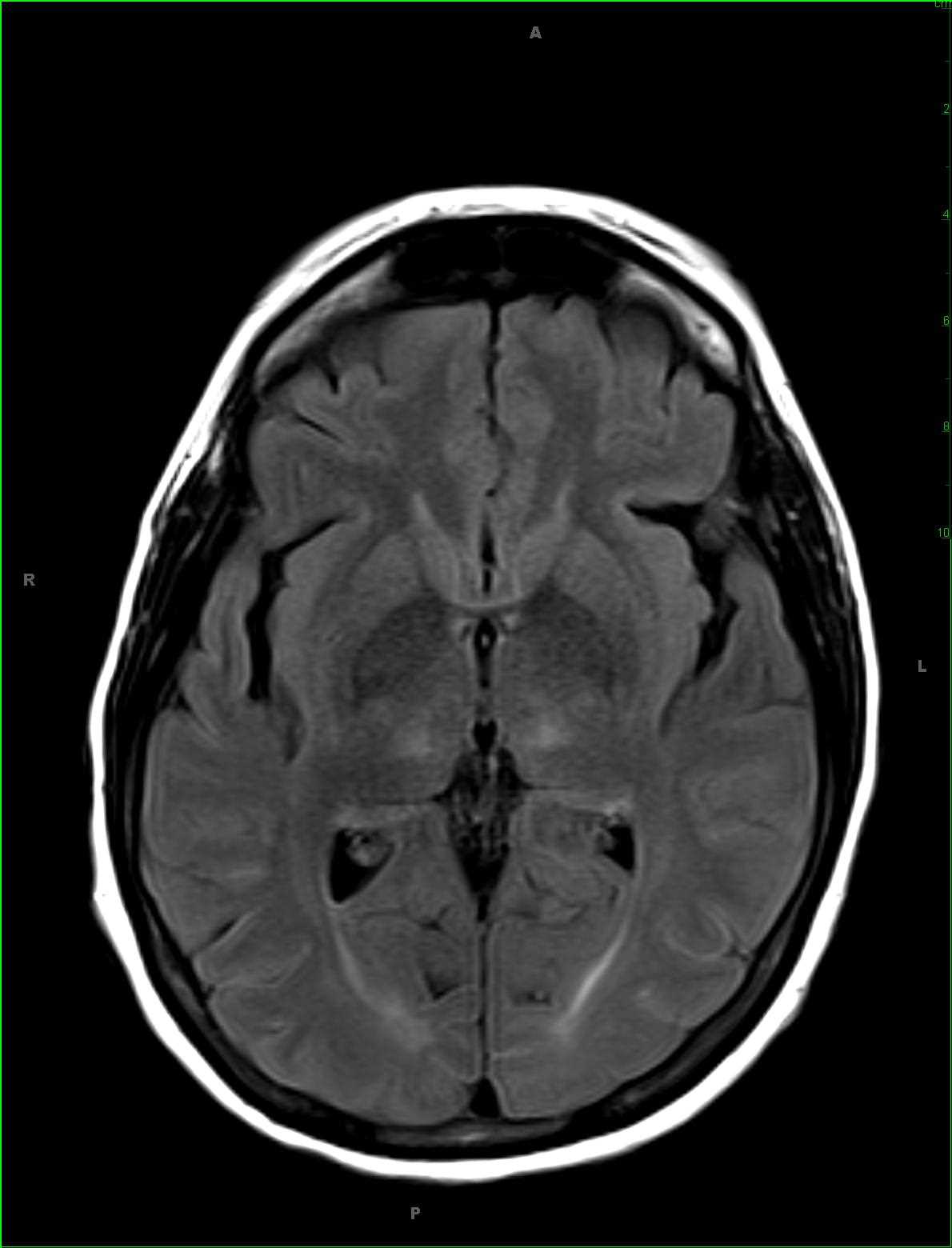 Hepatic Encephalopathy, Secondary to Acetaminophen Overdose - CTisus CT Scan