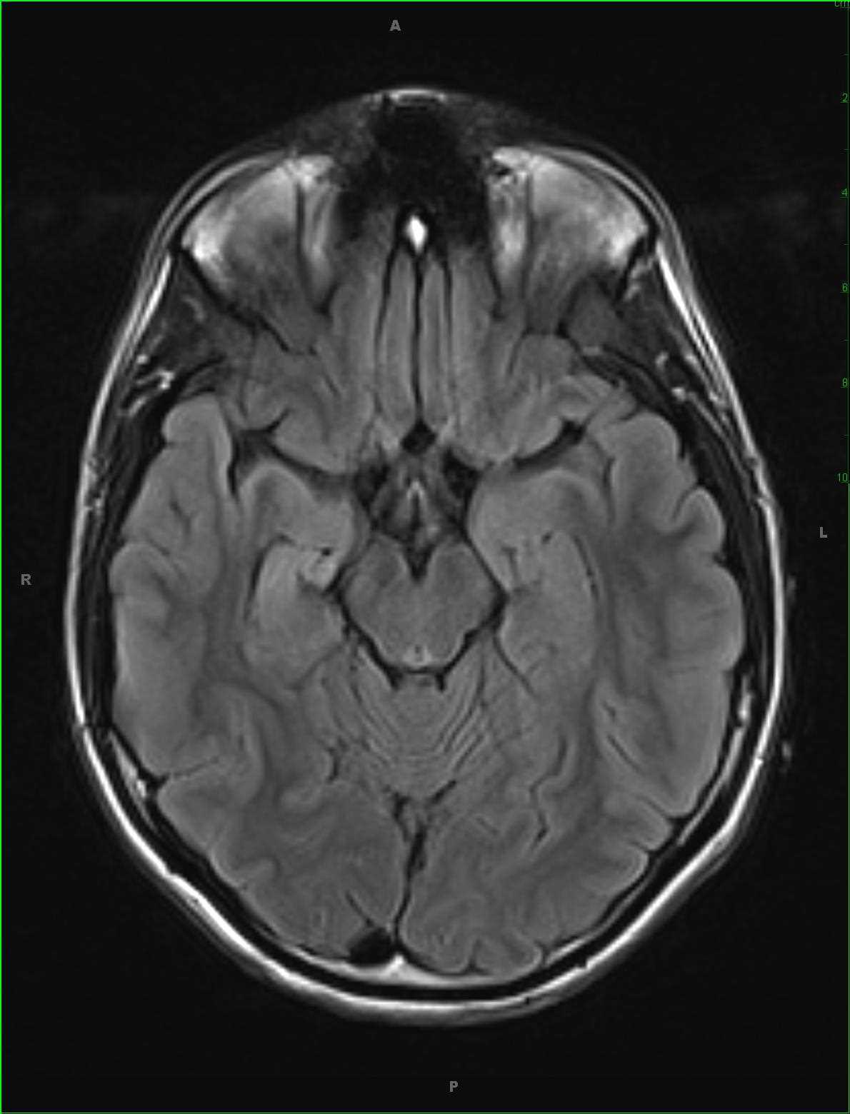 Mesial Temporal Sclerosis Right - CTisus CT Scan