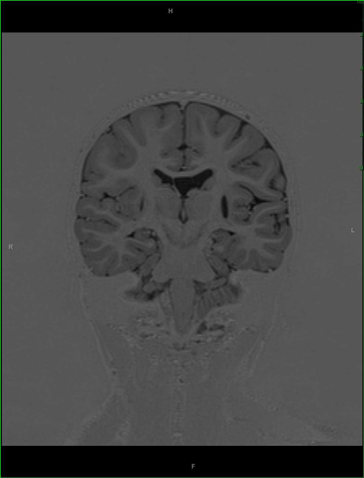 Prior Hypoxic Ischemic Insult with Wallerian Degeneration - CTisus CT Scan