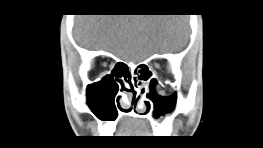 Orbital Floor Fracture - CTisus CT Scan