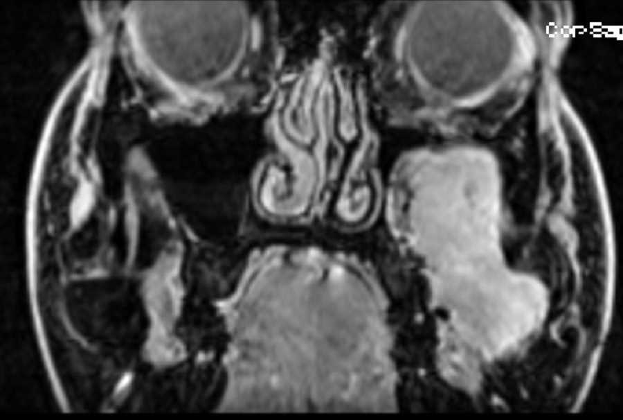 Juvenile Angiofibroma - CTisus CT Scan