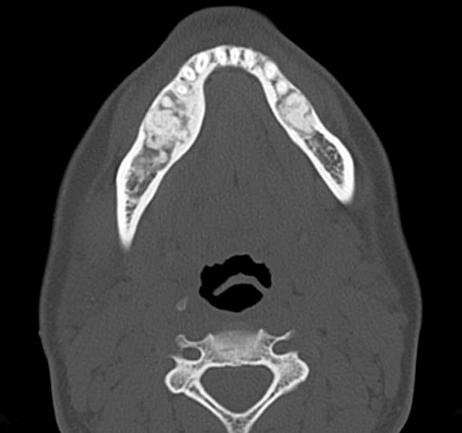 Periapical Cemento-Osseous Dysplasia - CTisus CT Scan