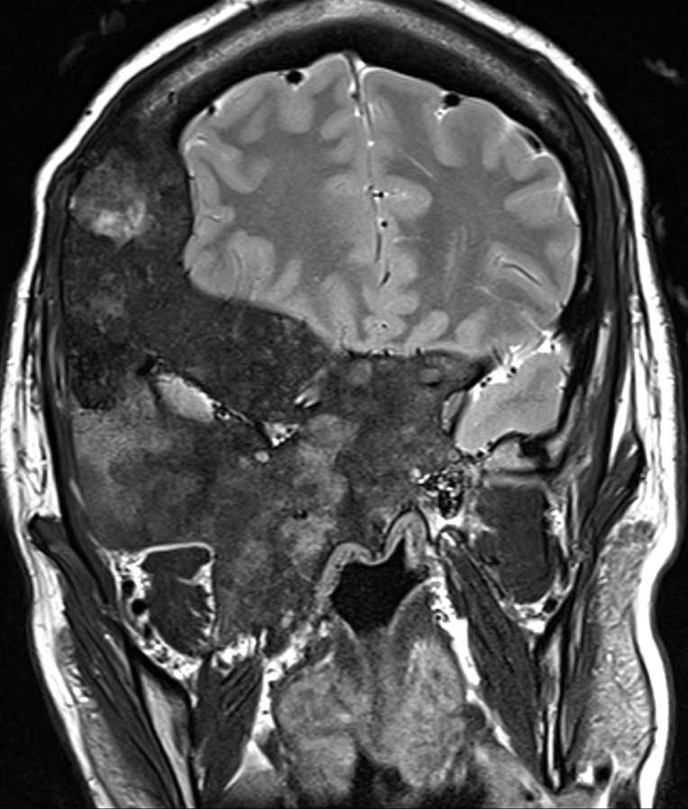 Fibrous Dysplasia-MRI - CTisus CT Scan