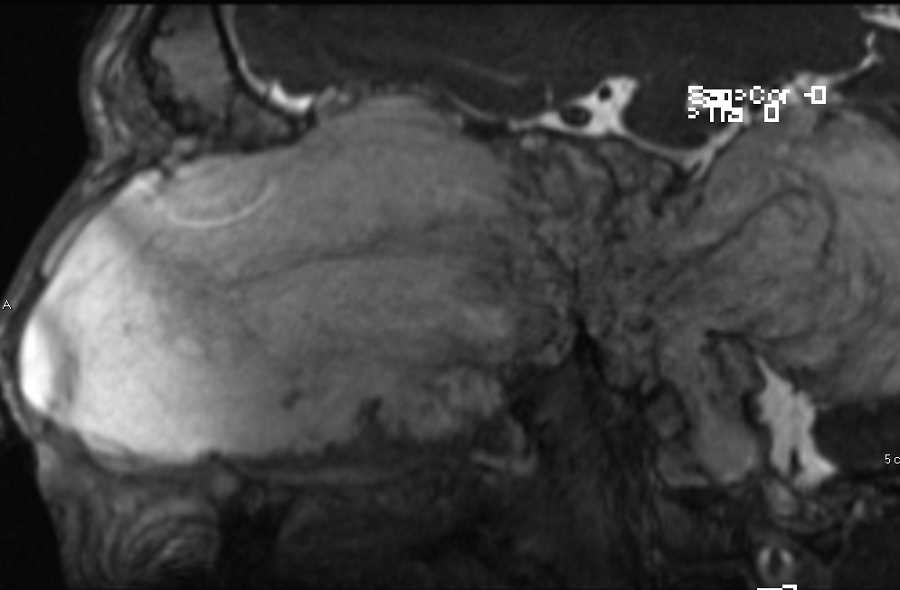 Myxoid Sarcoma of the Skull Base - CTisus CT Scan