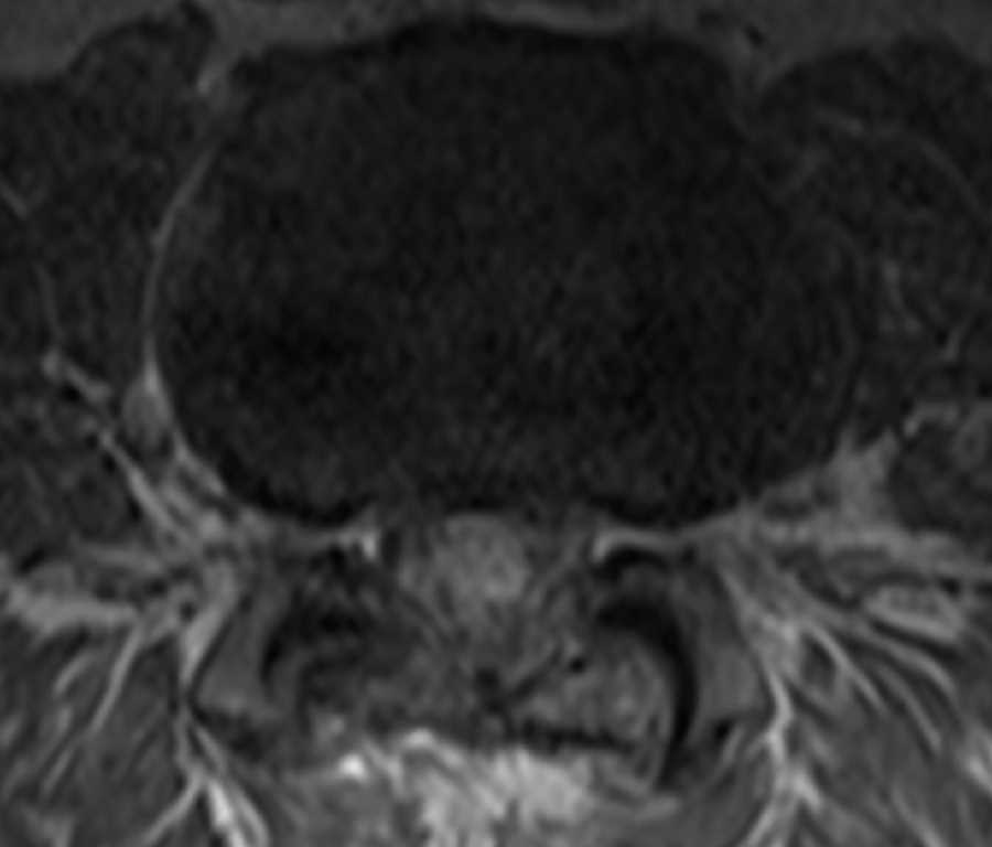 Spinal Hemangioblastomatosis - CTisus CT Scan