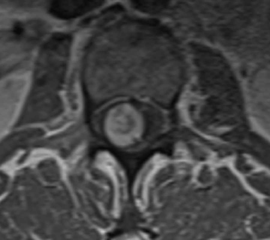 Intradural Schwannoma - CTisus CT Scan
