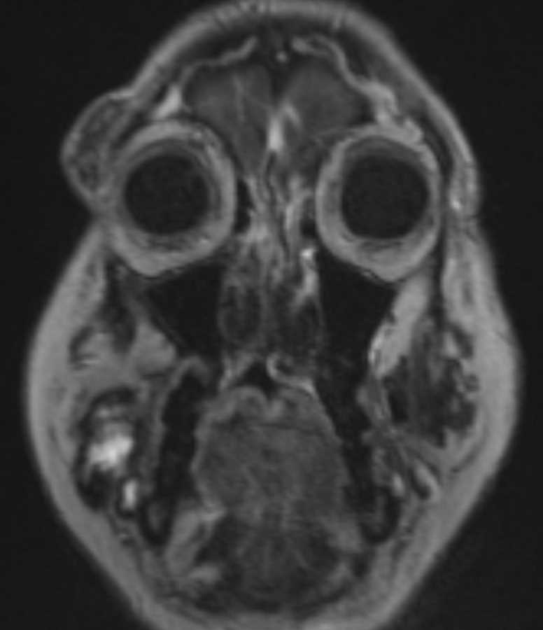 Venous Malformations - CTisus CT Scan