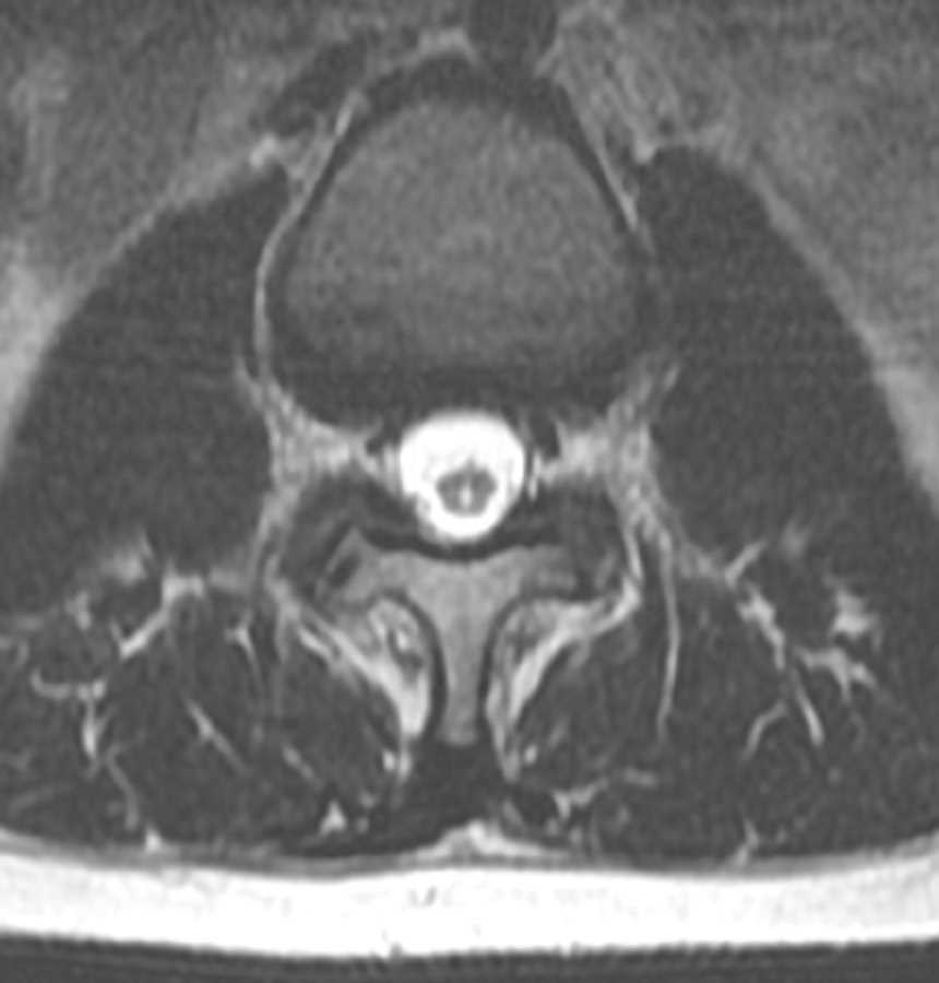 Tethered Cord - CTisus CT Scan