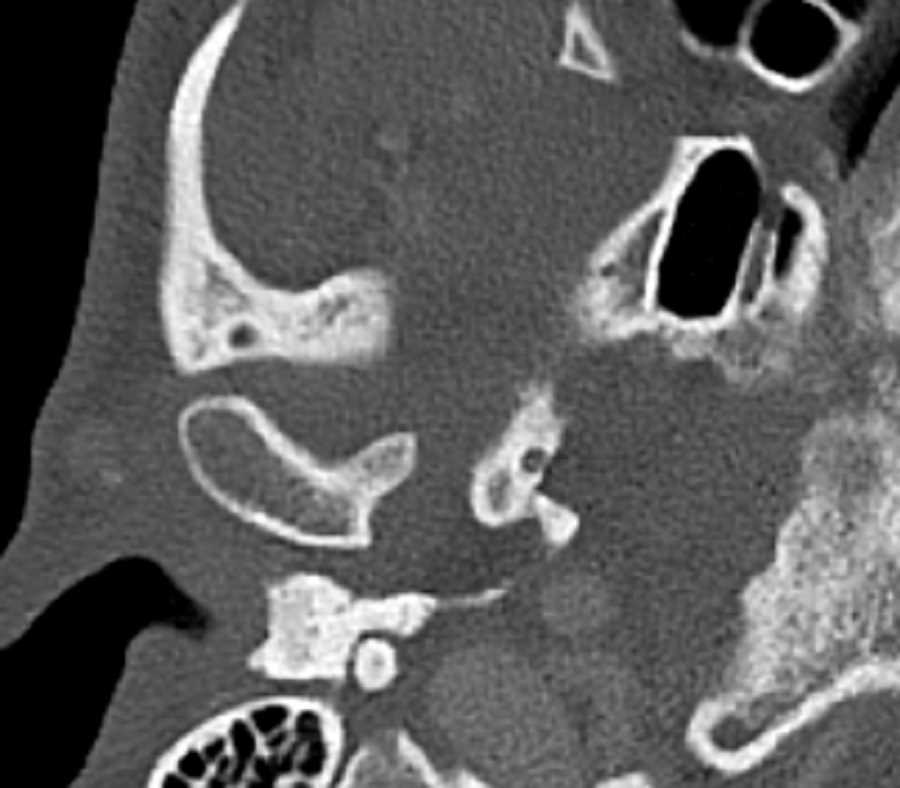 Mandibular Condyle Osteochondroma - CTisus CT Scan