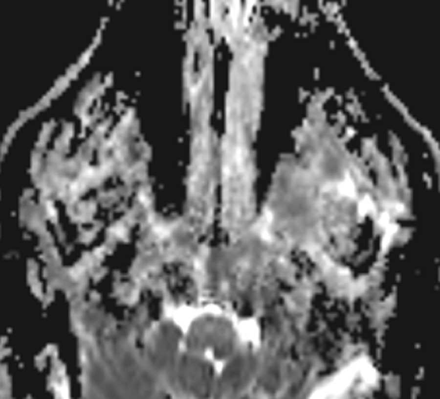 CN V3 Schwannoma - CTisus CT Scan