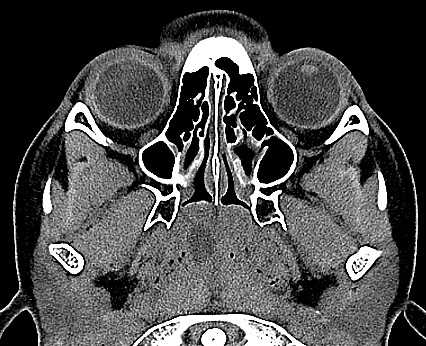 Nasopharyngeal Retention Cyst - CTisus CT Scan