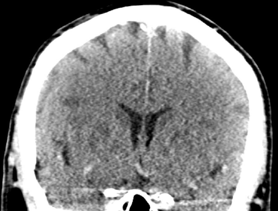 Adult Hypoxic Ischemic Injury - CTisus CT Scan