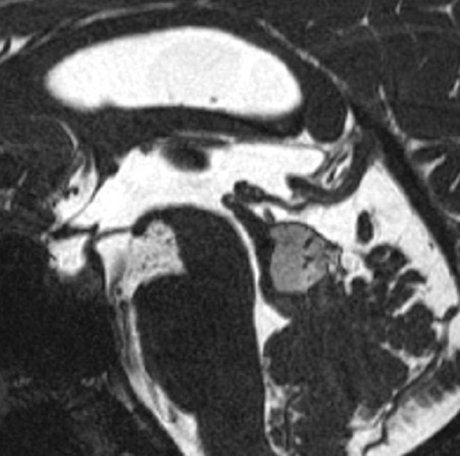 Tectal Plate Lipoma - CTisus CT Scan