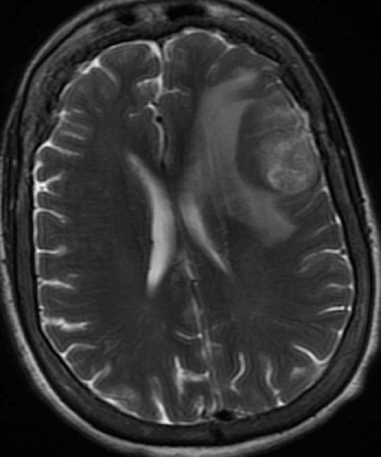 Anaplastic Oligodendroglioma - CTisus CT Scan