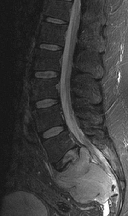 Multiple Myeloma - CTisus CT Scan
