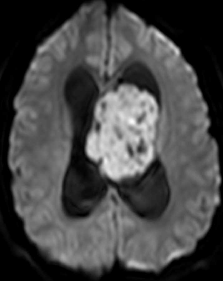 Ependymoma - CTisus CT Scan