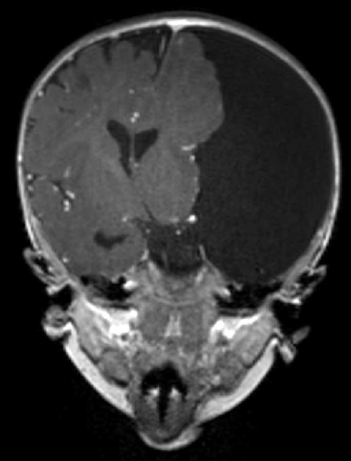 Arachnoid Cyst - CTisus CT Scan
