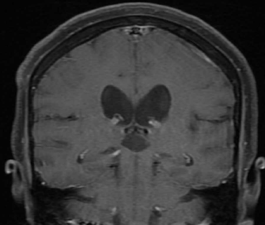 Pineal Gland Cyst - CTisus CT Scan